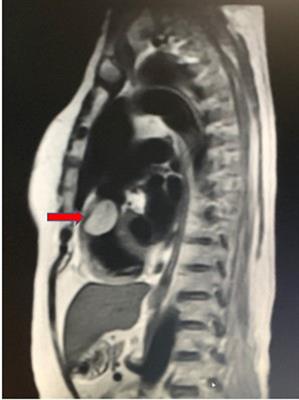 Case report: obstruction in the right ventricular outflow tract due to hemolymphangioma
